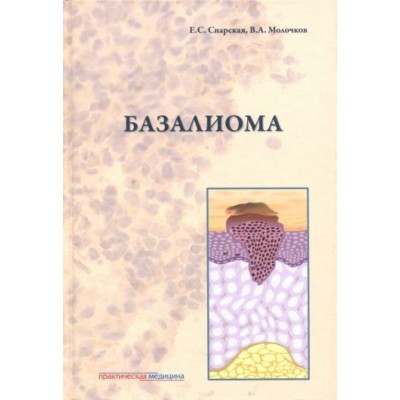 снарская, молочков: базалиома снарская, молочков: базалиома