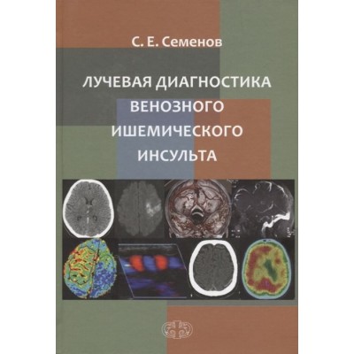 Лучевая диагностика венозного ишемического инсульта Лучевая диагностика венозного ишемического инсульта